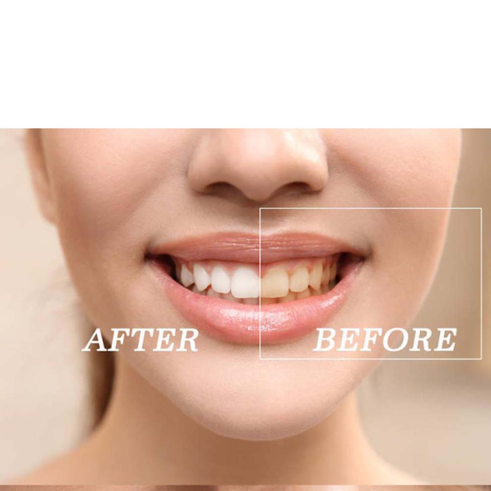 Najwyższej jakości zestaw żelo – Teeth Whitening Bleach recenzja i cena